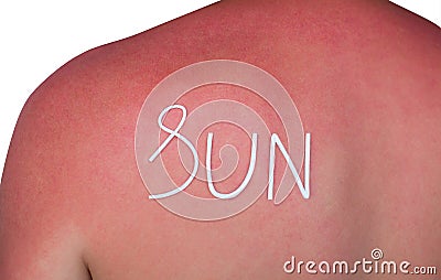 Man with reddened, itchy skin after sunburn. Cream on the back. Stock Photo