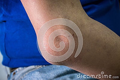 Man with right elbow with cellulitis Stock Photo