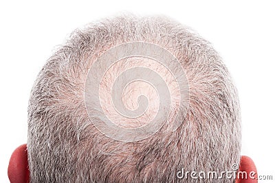 Man scalp with hair loss problem Stock Photo