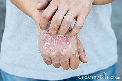 Man scratch oneself, dry flaky skin on hand with psoriasis vulgaris, eczema and other skin conditions like fungus, plaque, rash an Stock Photo