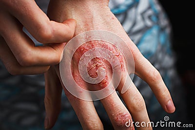 Man scratch oneself, dry flaky skin on hand with psoriasis vulgaris, eczema and other skin conditions like fungus Stock Photo