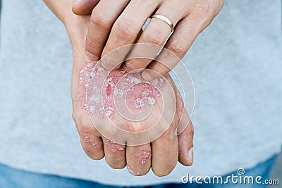 Man scratch oneself, dry flaky skin on hand with psoriasis vulgaris, eczema and other skin conditions like fungus, plaque, rash an Stock Photo