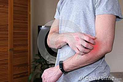 A man scratching an itchy hand. Dermatitis, eczema, allergies, psoriasis. Close-up of a man with an itchy rash on his arm, the Stock Photo