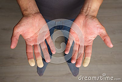 Man showing hands with Raynaud syndrome, Raynaud's phenomenon or Raynaud's disease Stock Photo