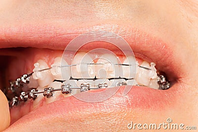 Man showing orthodontics and bite correction Stock Photo