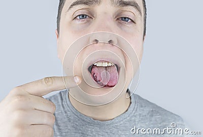 Black tongue. A man shows the consequences of an injury, bite or burn of the tongue. Part is damaged. Treatment of internal Stock Photo