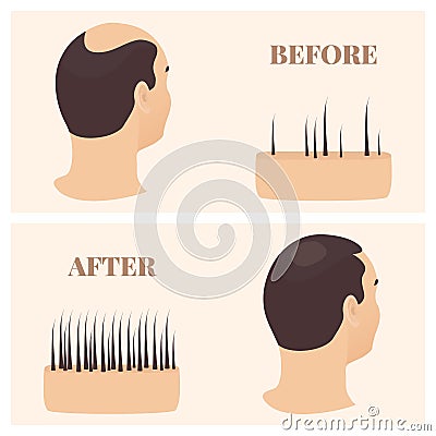 Man in side view before and after hair loss treatment Vector Illustration