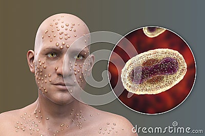 A man with smallpox disease and close-up view of variola virus, a virus from Orthopoxviridae family that causes smallpox Cartoon Illustration