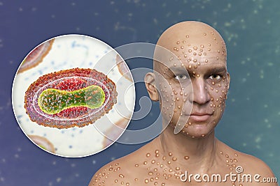 A man with smallpox disease and close-up view of variola virus, a virus from Orthopoxviridae family that causes smallpox Cartoon Illustration