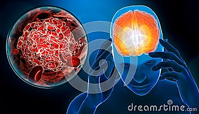 Man suffering of a cerebrovascular accident or stroke or brain attack with blood clot or thrombus 3D rendering illustration. Cartoon Illustration