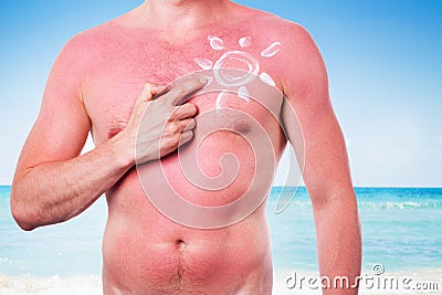 Man with a sunburn Stock Photo