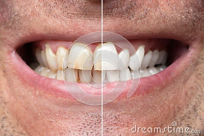 Man Teeth Before And After Whitening Stock Photo