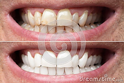 Man Teeth Before And After Whitening Stock Photo