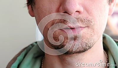 Herpes. Lip treatment. Close-up of the man`s lips with herpes. Front view. Stock Photo