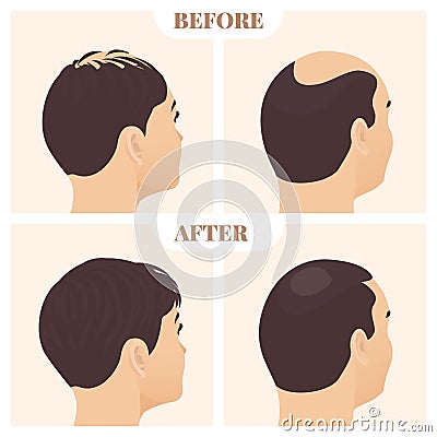 Man and woman in side view before and after hair loss treatment Vector Illustration