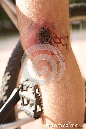 Man with a wound on his knee Stock Photo