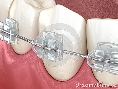Mandibular jaw and Clear braces. Medically accurate dental 3D illustration Cartoon Illustration