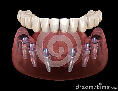 Mandibular prosthesis All on 6 system supported by implants. Medically accurate 3D illustration of human teeth Cartoon Illustration