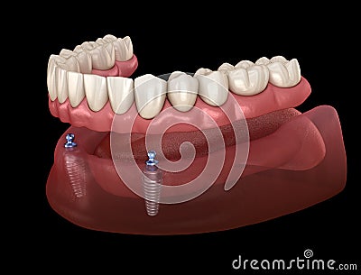 Mandibular removable prosthesis All on 2 system supported by implants with ball attachments. Medically accurate dental Cartoon Illustration