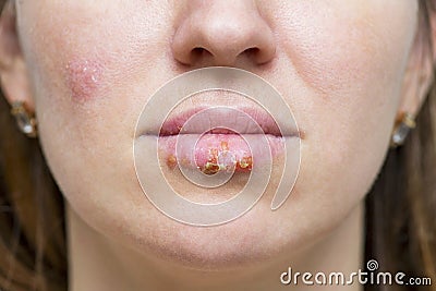 Manifestation of the herpes virus on the lips closeup. Part of a young woman`s face with a virus herpes on lips Stock Photo