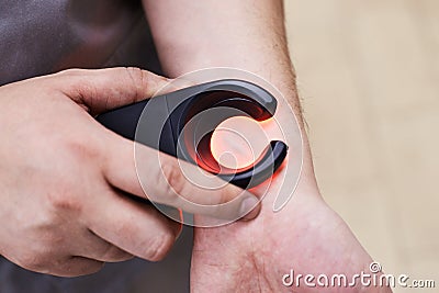 Manifestation veins. Laser removal. Treatment varicose veins Stock Photo