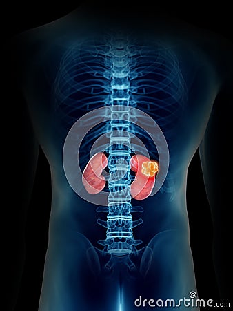 A mans kidney tumor Cartoon Illustration