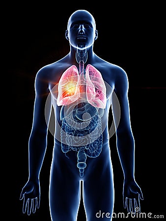 A mans lung cancer Cartoon Illustration