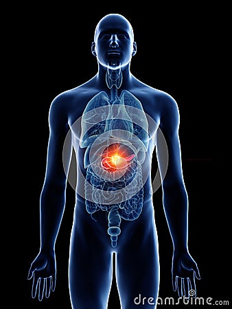 A mans pancreas cancer Cartoon Illustration