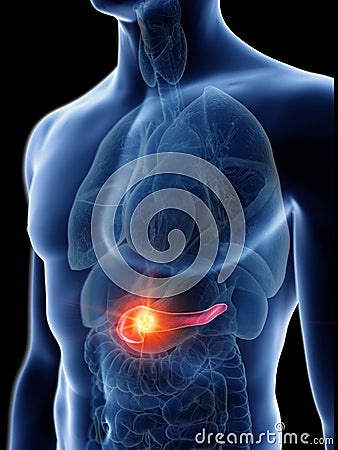 a mans pancreas tumor Cartoon Illustration