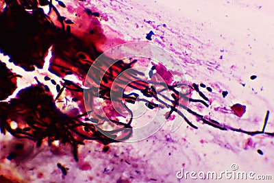 Many of septate hyphae or fungus cells in sputum smear Stock Photo