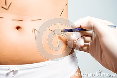 Marking abdomen for cosmetic correction surgery Stock Photo