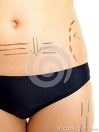 Marks on abdomen and thigh for cosmetic surgery Stock Photo