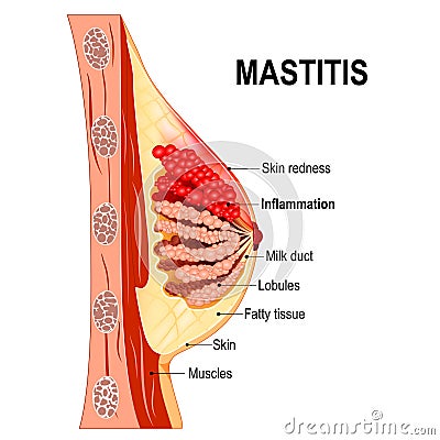 Mastitis. Cross-section of the mammary gland with inflammation o Vector Illustration