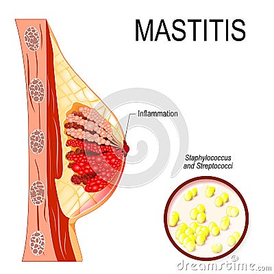 Mastitis. inflammation of the breast abscess formation. Vector Illustration