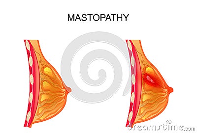 Mastopathy. healthy and diseased mammary gland Vector Illustration