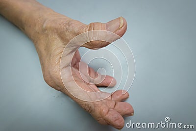 Mature patient with osteoarthritis on the hands Stock Photo