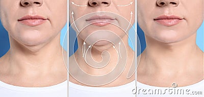 Mature woman before and after plastic surgery operation on blue background. Double chin problem Stock Photo