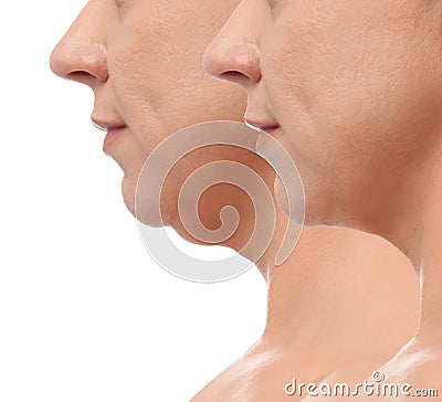 Mature woman before and after plastic surgery operation on white background. Double chin problem Stock Photo