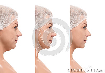 Mature woman before and after plastic surgery on white background. Double chin problem Stock Photo