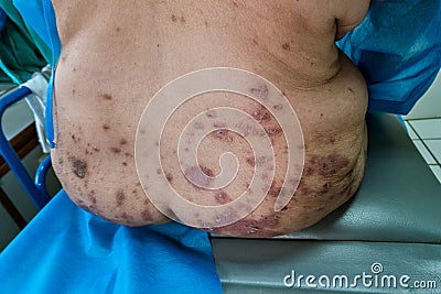 Mature woman with psoriasis in the lower back. Stock Photo