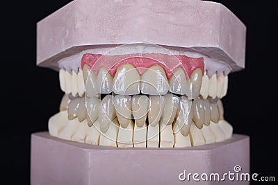 Maxilla and mandible bridge Stock Photo