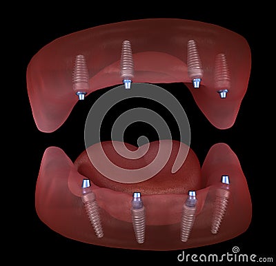 Maxillary and Mandibular prosthesis with gum All on 4 system supported by implants. Medically accurate 3D illustration Cartoon Illustration