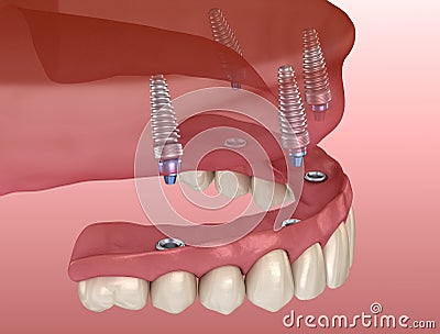 Maxillary prosthesis with gum All on 4 system supported by implants. Medically accurate 3D illustration of human teeth Cartoon Illustration