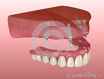 Maxillary prosthesis with gum All on 4 system supported by implants. Medically accurate 3D illustration of human teeth Cartoon Illustration