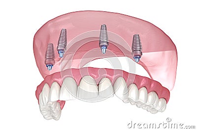 Maxillary prosthesis with gum All on 4 system supported by implants. Medically accurate 3D illustration of human teeth and Cartoon Illustration