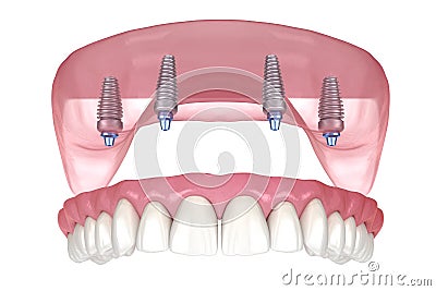 Maxillary prosthesis with gum All on 4 system supported by implants. Medically accurate 3D illustration of human teeth and Cartoon Illustration