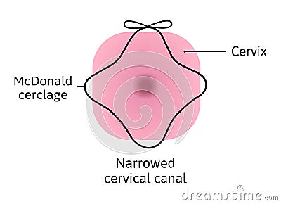 McDonald cerclage tightening of cervix opening during pregnancy. Anatomy of cervical canal. cervix weakness and black Vector Illustration