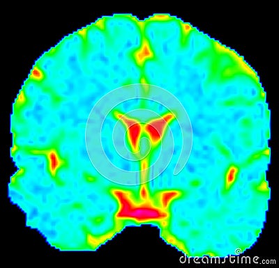 Mean Diffusivity Brain Map in Coronal View Stock Photo