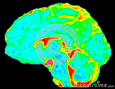 Mean Diffusivity Brain Map in Sagittal View Stock Photo