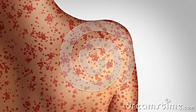 Measles Concept Cartoon Illustration